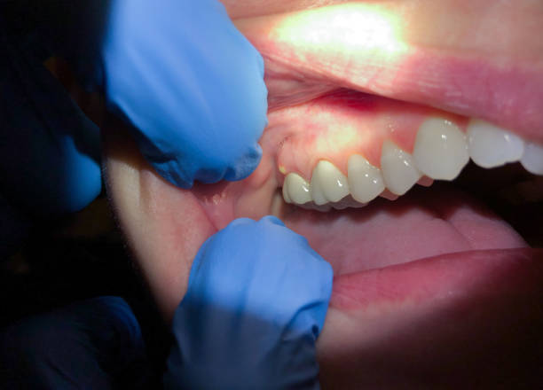 Best Emergency Dentist for Lost Fillings or Crowns in Monteagle, TN